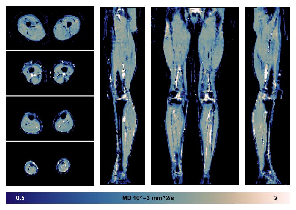 IVIM corrected whole leg muscle mean diffusivity obtained from diffusion tensor imaging.